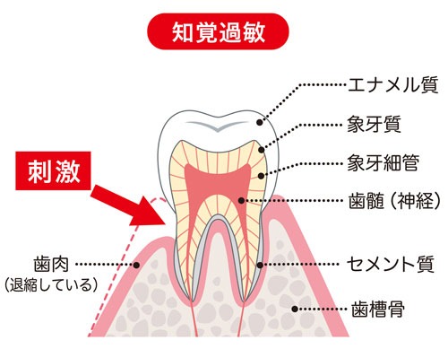 知覚過敏の治療