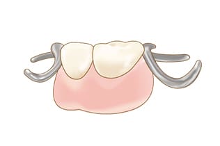 クラスプデンチャー