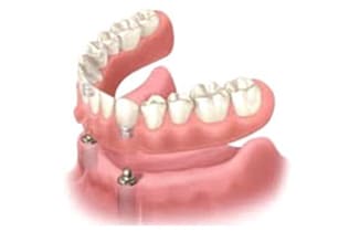 インプラントデンチャー