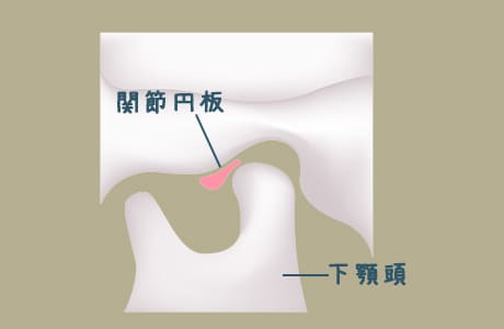 関節円板が前方にズレて変形してる