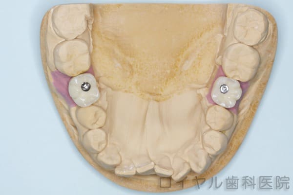 インプラント症例2模型作成1