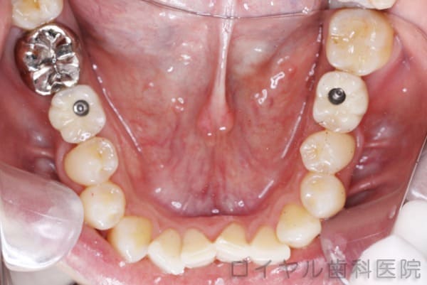 インプラント治療2術後1