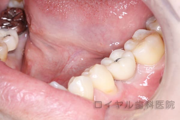 インプラント治療2術後2