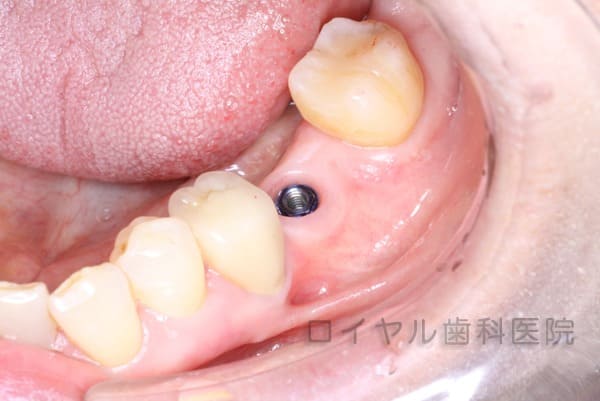 インプラント治療3術中
