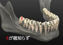親知らずの抜歯について