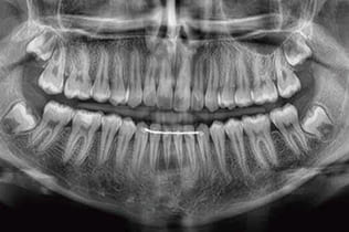 レントゲン検査